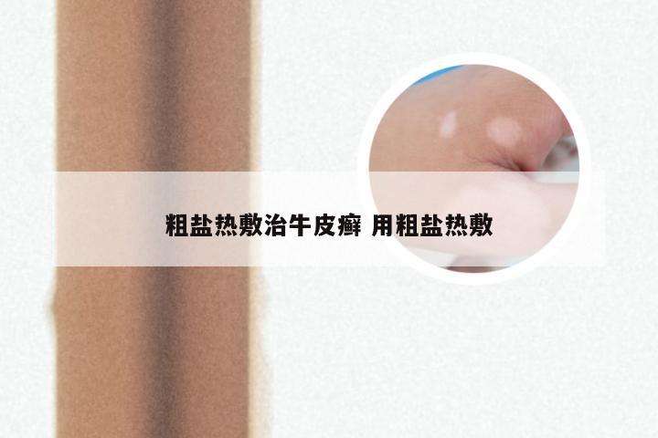 粗盐热敷治牛皮癣 用粗盐热敷
