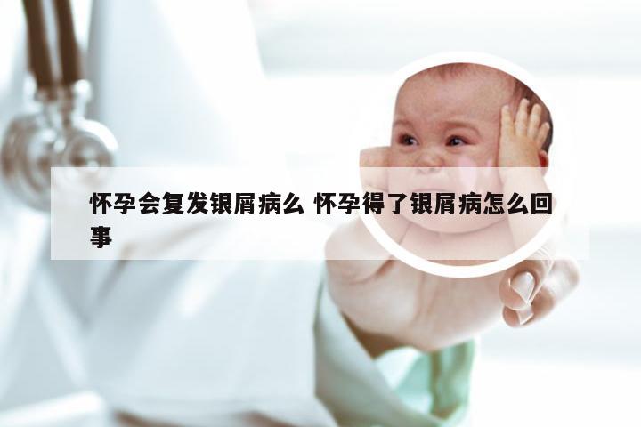 怀孕会复发银屑病么 怀孕得了银屑病怎么回事