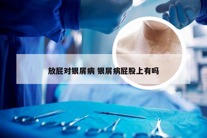 放屁对银屑病 银屑病屁股上有吗