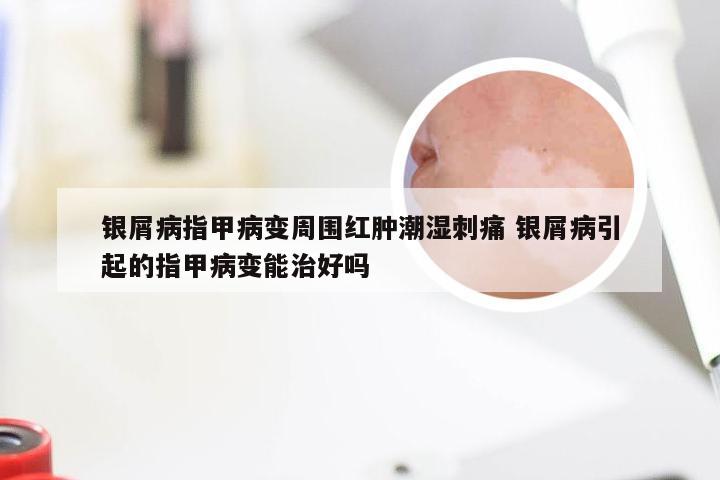 银屑病指甲病变周围红肿潮湿刺痛 银屑病引起的指甲病变能治好吗