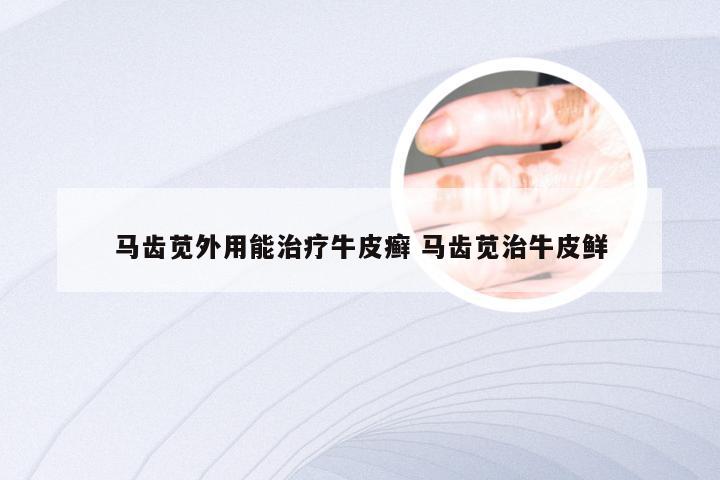 马齿苋外用能治疗牛皮癣 马齿苋治牛皮鲜