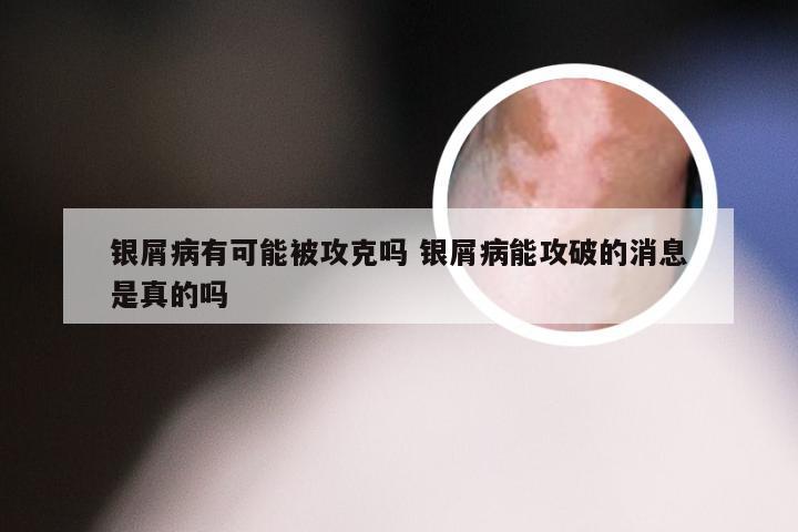 银屑病有可能被攻克吗 银屑病能攻破的消息是真的吗