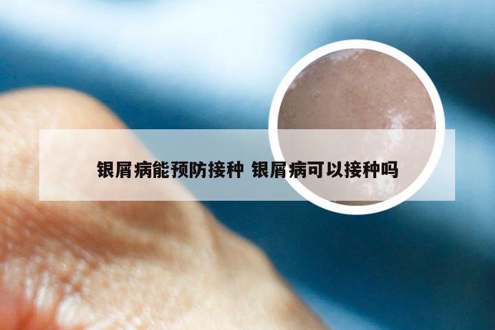 银屑病能预防接种 银屑病可以接种吗