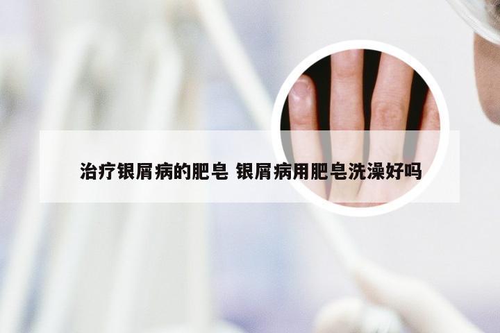 治疗银屑病的肥皂 银屑病用肥皂洗澡好吗