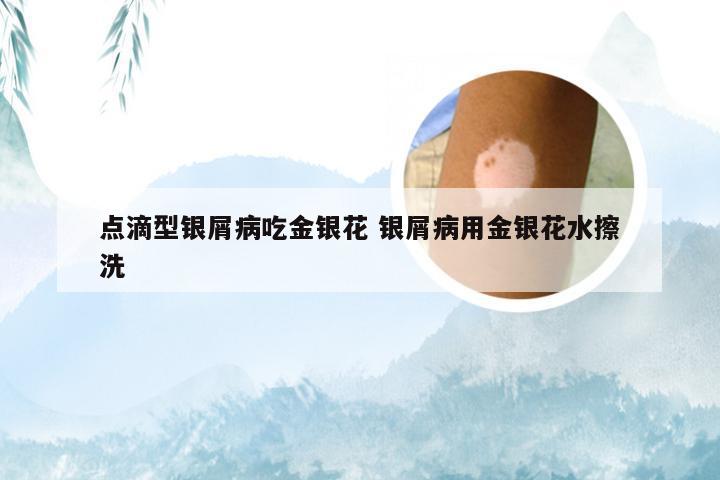 点滴型银屑病吃金银花 银屑病用金银花水擦洗