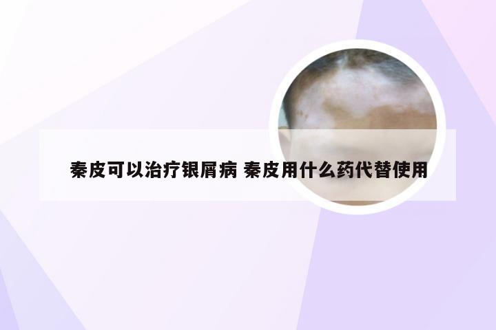 秦皮可以治疗银屑病 秦皮用什么药代替使用