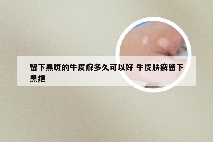 留下黑斑的牛皮癣多久可以好 牛皮肤癣留下黑疤