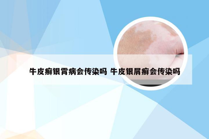 牛皮癣银霄病会传染吗 牛皮银屑癣会传染吗
