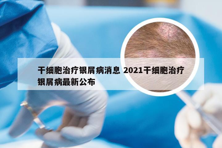 干细胞治疗银屑病消息 2021干细胞治疗银屑病最新公布