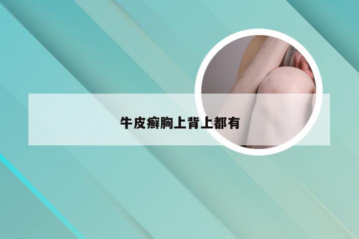 牛皮癣胸上背上都有
