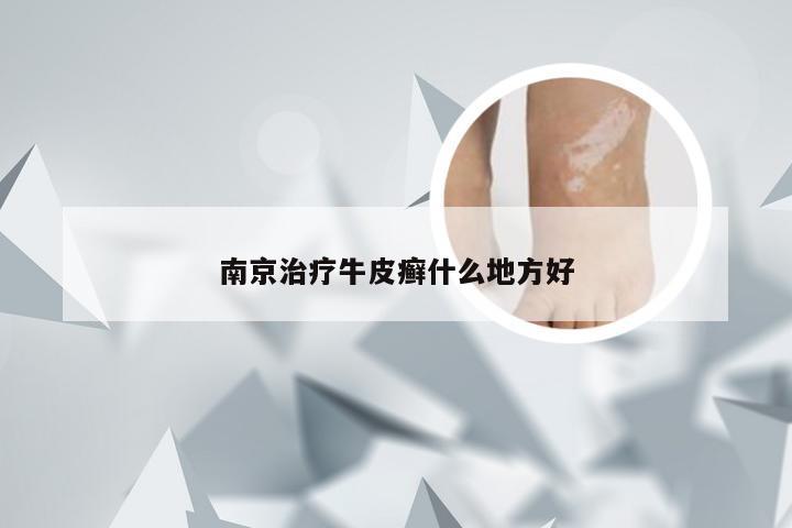 南京治疗牛皮癣什么地方好