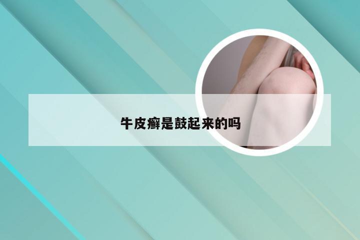 牛皮癣是鼓起来的吗