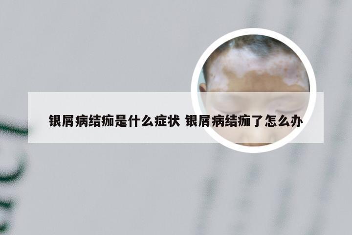 银屑病结痂是什么症状 银屑病结痂了怎么办