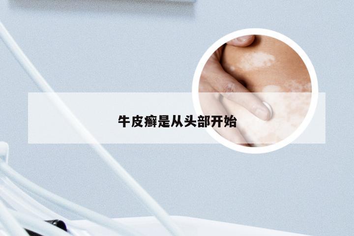 牛皮癣是从头部开始