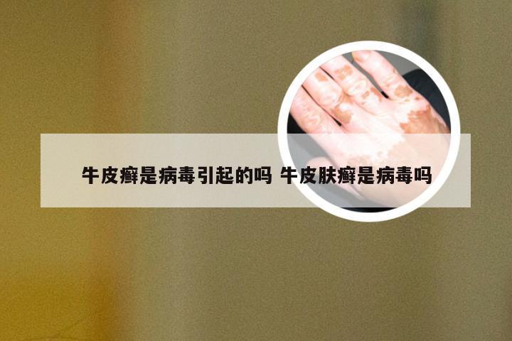 牛皮癣是病毒引起的吗 牛皮肤癣是病毒吗