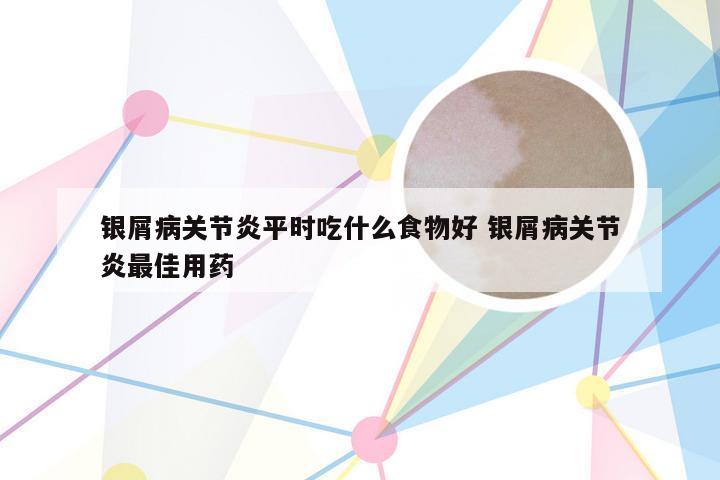 银屑病关节炎平时吃什么食物好 银屑病关节炎最佳用药