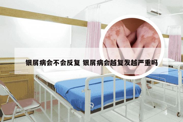 银屑病会不会反复 银屑病会越复发越严重吗