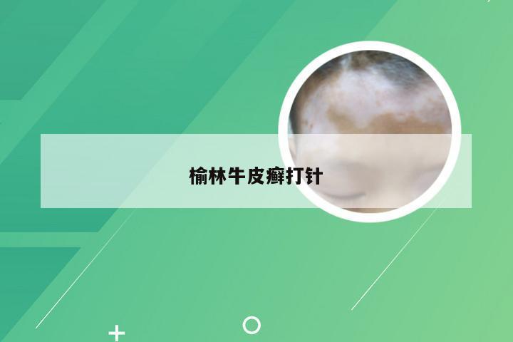 榆林牛皮癣打针