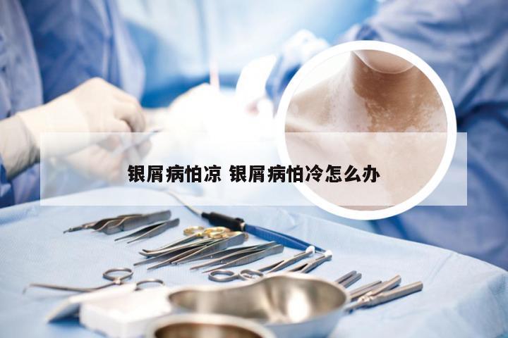 银屑病怕凉 银屑病怕冷怎么办