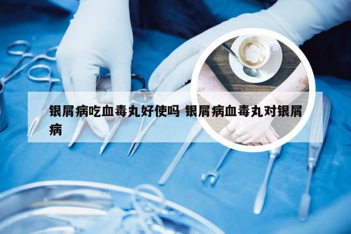 银屑病吃血毒丸好使吗 银屑病血毒丸对银屑病