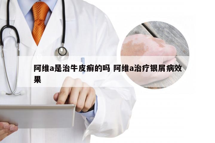 阿维a是治牛皮癣的吗 阿维a治疗银屑病效果