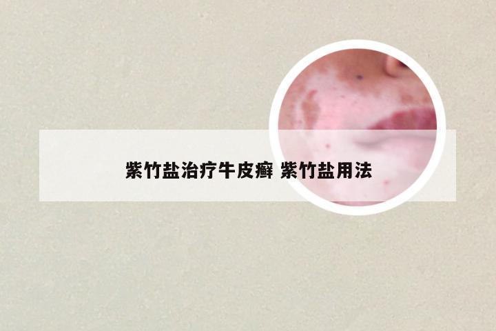 紫竹盐治疗牛皮癣 紫竹盐用法