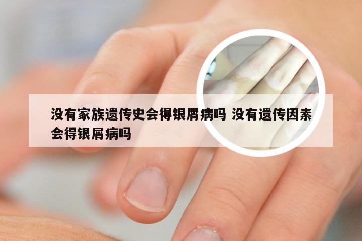 没有家族遗传史会得银屑病吗 没有遗传因素会得银屑病吗