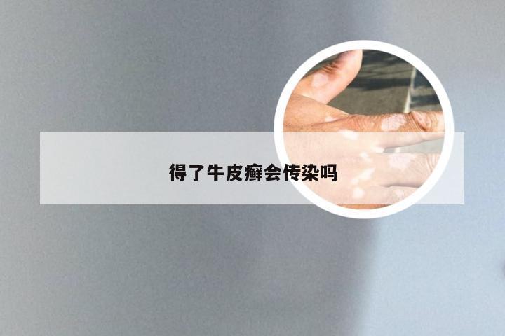 得了牛皮癣会传染吗