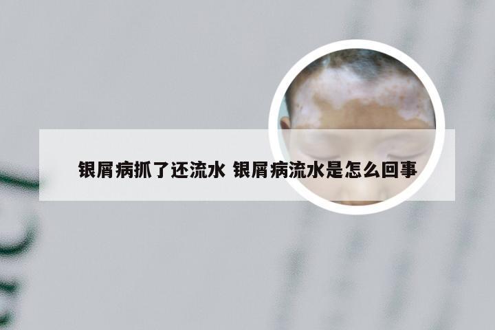 银屑病抓了还流水 银屑病流水是怎么回事