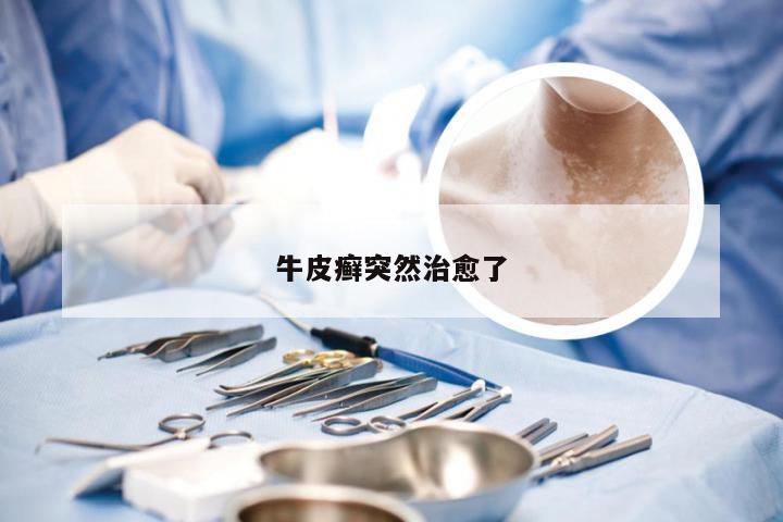 牛皮癣突然治愈了