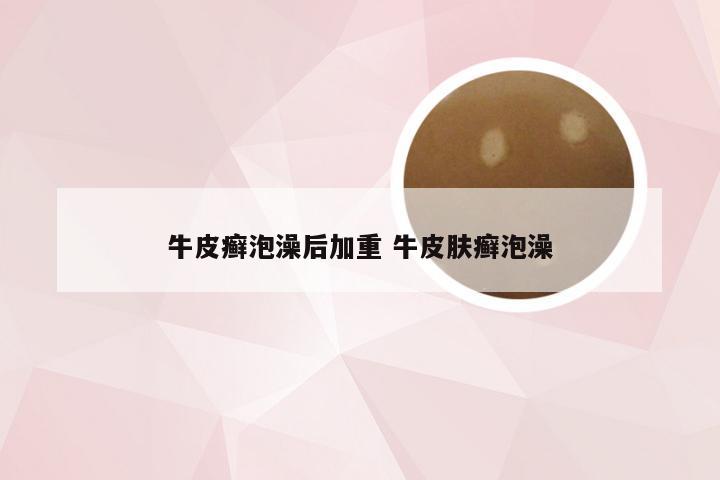 牛皮癣泡澡后加重 牛皮肤癣泡澡