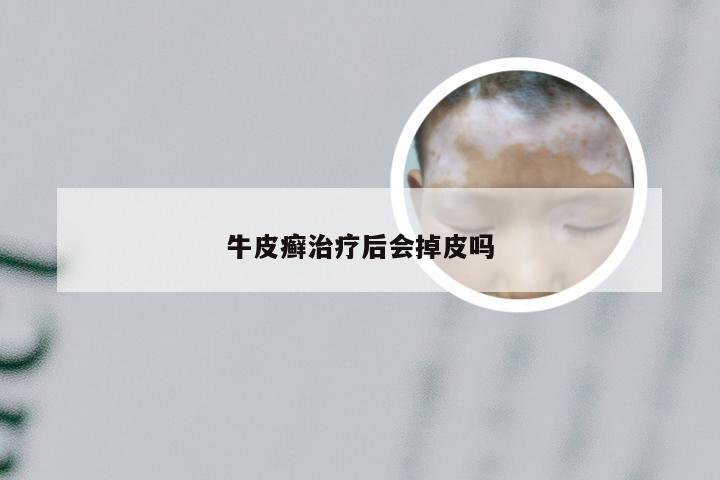 牛皮癣治疗后会掉皮吗