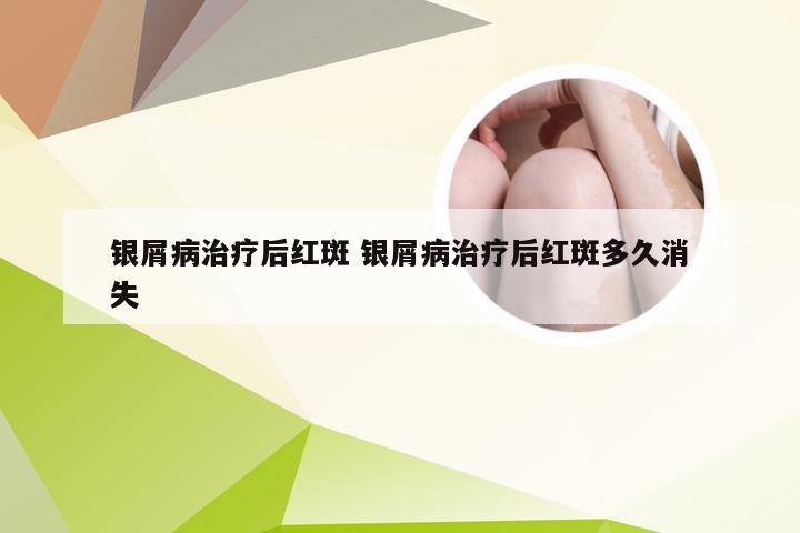 银屑病治疗后红斑 银屑病治疗后红斑多久消失