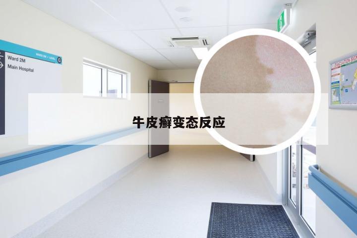牛皮癣变态反应
