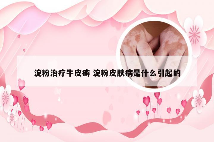 淀粉治疗牛皮癣 淀粉皮肤病是什么引起的