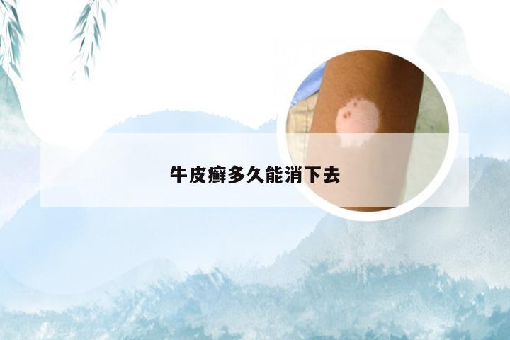 牛皮癣多久能消下去