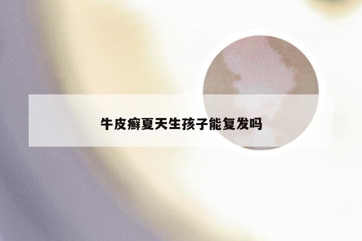 牛皮癣夏天生孩子能复发吗