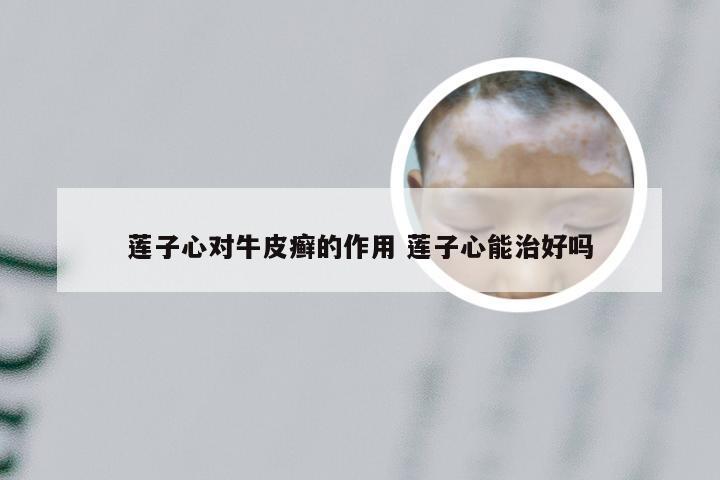 莲子心对牛皮癣的作用 莲子心能治好吗