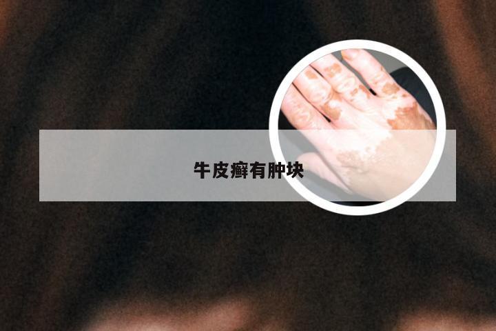 牛皮癣有肿块
