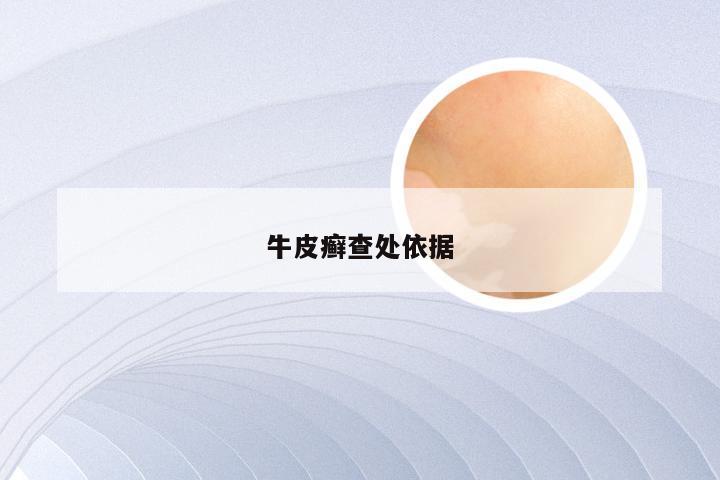 牛皮癣查处依据