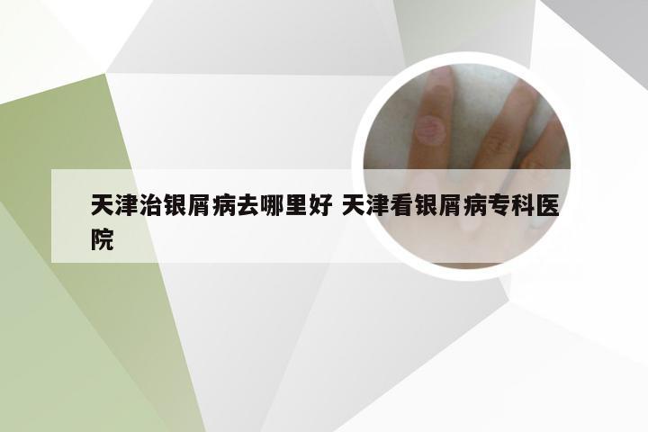 天津治银屑病去哪里好 天津看银屑病专科医院