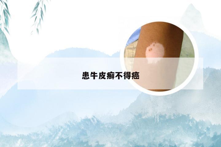 患牛皮癣不得癌