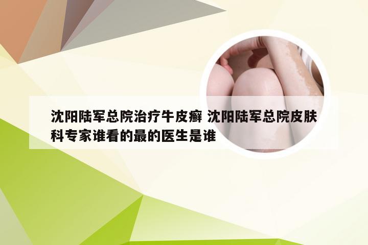 沈阳陆军总院治疗牛皮癣 沈阳陆军总院皮肤科专家谁看的最的医生是谁