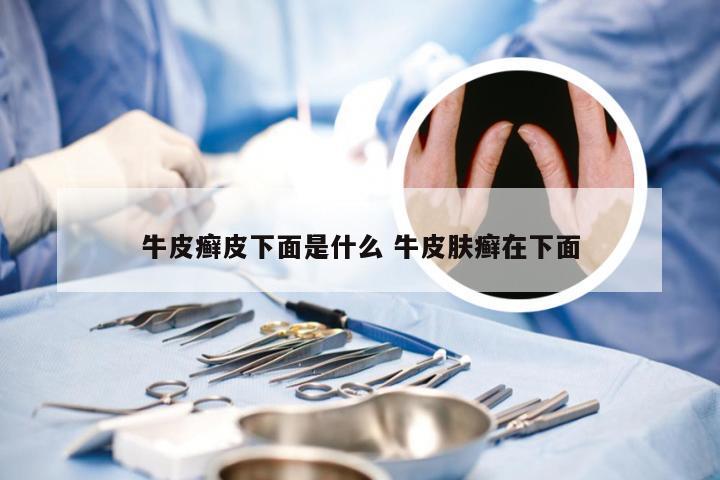 牛皮癣皮下面是什么 牛皮肤癣在下面
