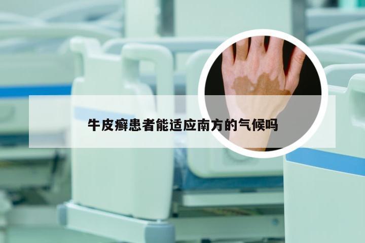 牛皮癣患者能适应南方的气候吗