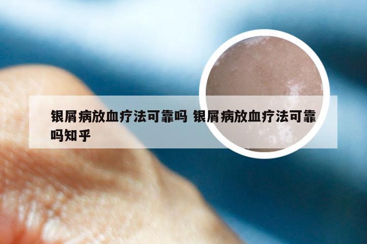 银屑病放血疗法可靠吗 银屑病放血疗法可靠吗知乎