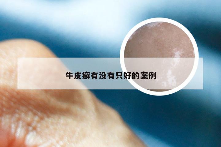 牛皮癣有没有只好的案例