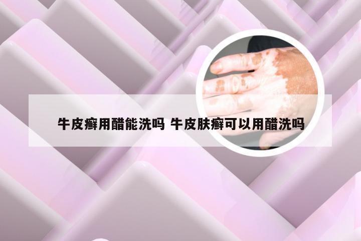 牛皮癣用醋能洗吗 牛皮肤癣可以用醋洗吗