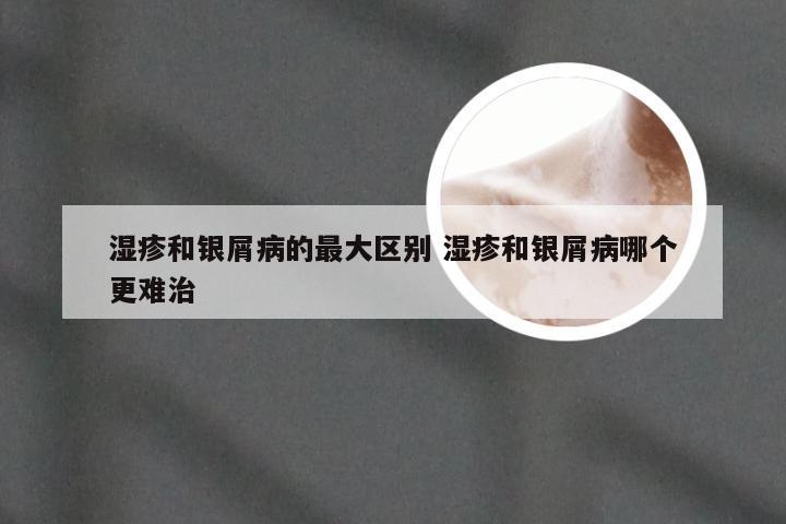 湿疹和银屑病的最大区别 湿疹和银屑病哪个更难治