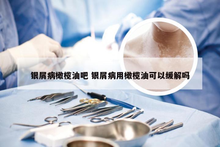 银屑病橄榄油吧 银屑病用橄榄油可以缓解吗